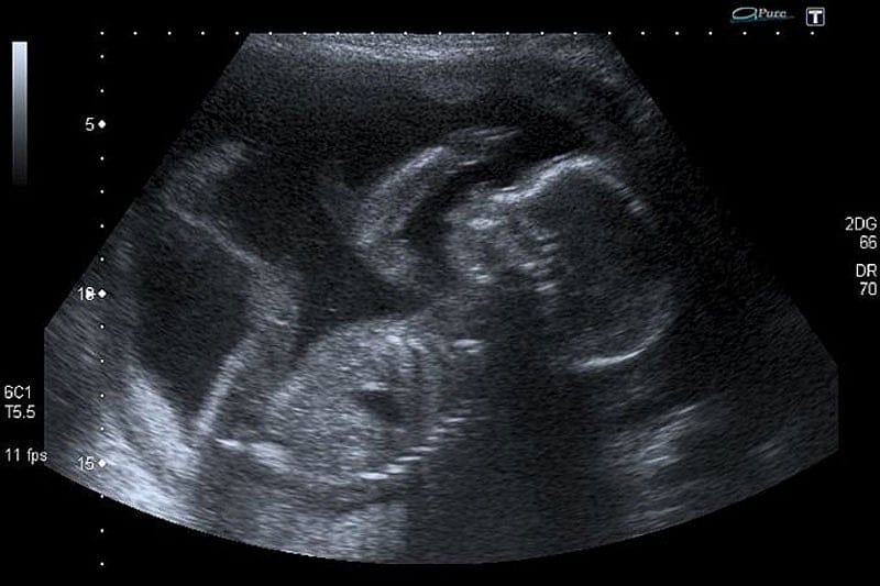 Pro-Abortion Groups Afraid Of Ending The Fillibuster