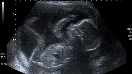 Charlie Baker Sounds Skeptical About ROE Act Abortion Bill; House Speaker Doesn’t Greenlight It, Either
