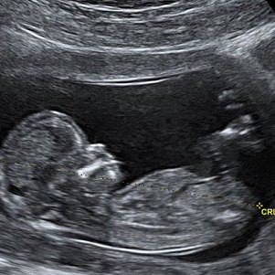 Twenty-One States Back South Carolina In Fetal Heartbeat Bill Appeal